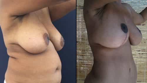 Breast Lift Colombia - Premium Care Plastic Surgery