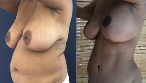 Breast Lift Colombia - Premium Care Plastic Surgery