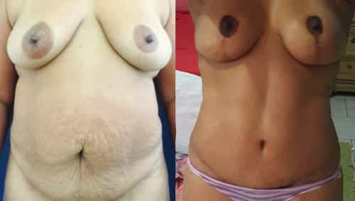 Breast Lift Colombia - Premium Care Plastic Surgery