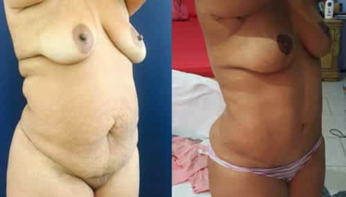 Breast Lift Colombia - Premium Care Plastic Surgery