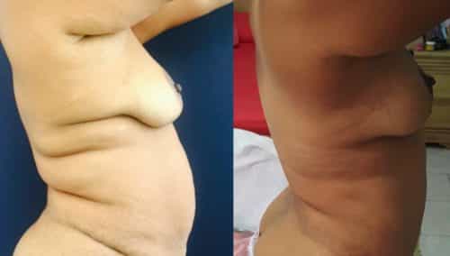 Breast Lift Colombia - Premium Care Plastic Surgery