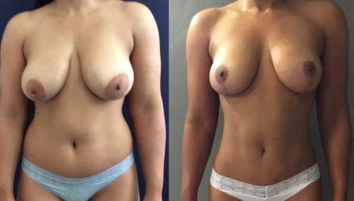 Breast Lift Colombia - Premium Care Plastic Surgery