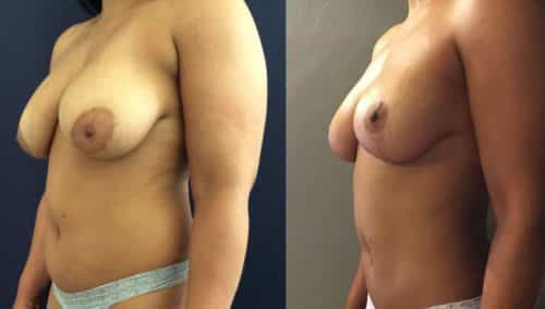 Breast Lift Colombia - Premium Care Plastic Surgery