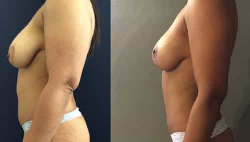 Breast Lift Colombia - Premium Care Plastic Surgery