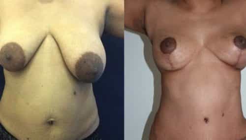Breast Lift Colombia - Premium Care Plastic Surgery