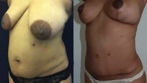Breast Lift Colombia - Premium Care Plastic Surgery