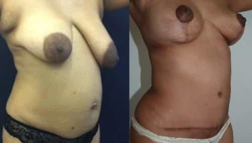 Breast Lift Colombia - Premium Care Plastic Surgery
