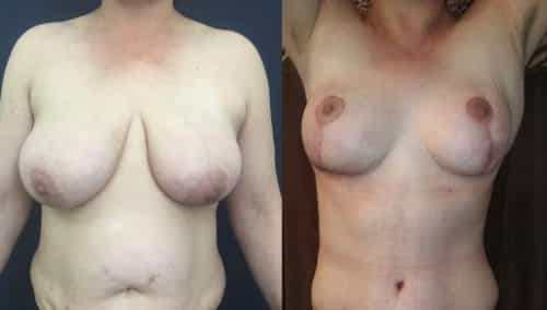 Breast Lift Colombia - Premium Care Plastic Surgery