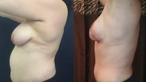 Breast Lift Colombia - Premium Care Plastic SurgeryBreast Lift Cartagena Colombia - Premium Care Plastic Surgery