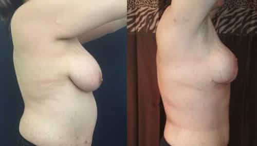 Breast Lift Colombia - Premium Care Plastic Surgery