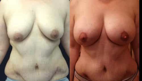 Breast Lift Colombia - Premium Care Plastic Surgery