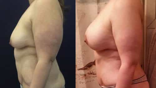 Breast Lift Colombia - Premium Care Plastic Surgery