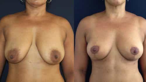 Breast Lift Colombia - Premium Care Plastic Surgery