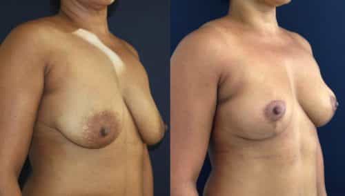 Breast Lift Colombia - Premium Care Plastic Surgery
