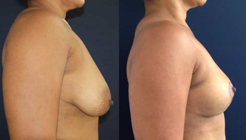 Breast Lift Colombia - Premium Care Plastic Surgery