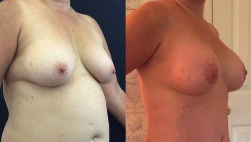 Breast Lift Colombia - Premium Care Plastic Surgery