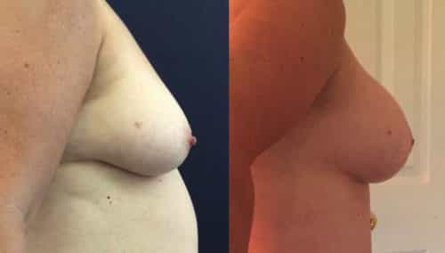 Breast Lift Colombia - Premium Care Plastic Surgery