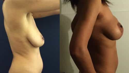 Breast Lift Cartagena Colombia - Premium Care Plastic Surgery