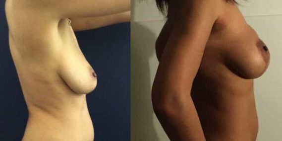 Breast Lift Cartagena Colombia - Premium Care Plastic Surgery