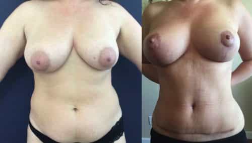 Breast Lift Colombia - Premium Care Plastic Surgery
