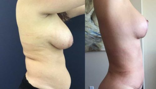 Breast Lift Colombia - Premium Care Plastic Surgery