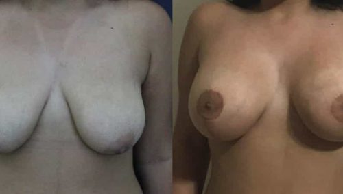 Breast Lift Colombia - Premium Care Plastic Surgery