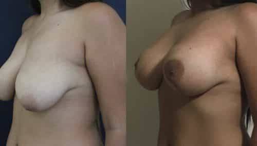 Breast Lift Colombia - Premium Care Plastic Surgery