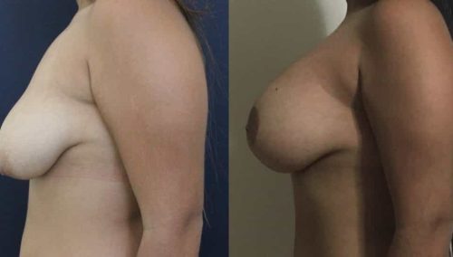 Breast Lift Colombia - Premium Care Plastic Surgery