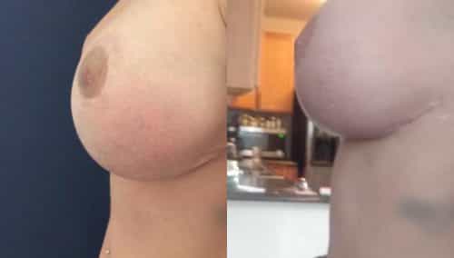 Before and after Breast Revision Colombia - Premium Care Plastic Surgery