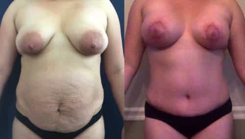 Breast Lift Colombia - Premium Care Plastic Surgery