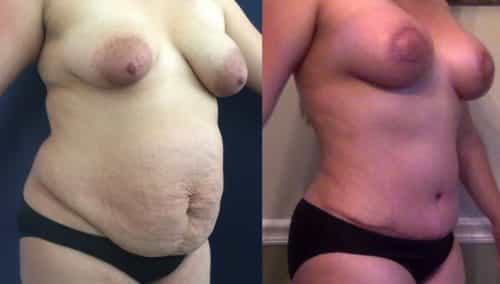 Breast Lift Colombia - Premium Care Plastic Surgery