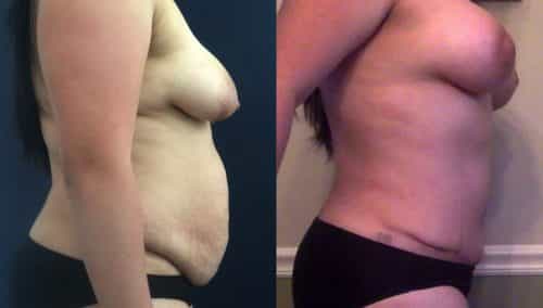 Breast Lift Colombia - Premium Care Plastic Surgery