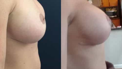 Before and after Breast Revision Colombia - Premium Care Plastic Surgery