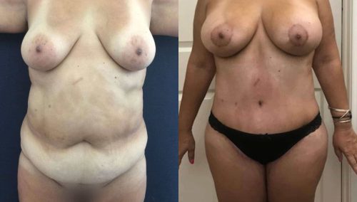 Breast Lift with Implants Colombia -Premium Care Plastic Surgery