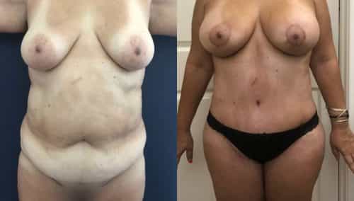 Breast Lift Augmentation Colombia - Premium Care Plastic Surgery