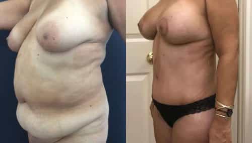 Breast Lift with Implants Colombia -Premium Care Plastic Surgery