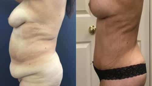 Breast Lift with Implants Colombia -Premium Care Plastic Surgery