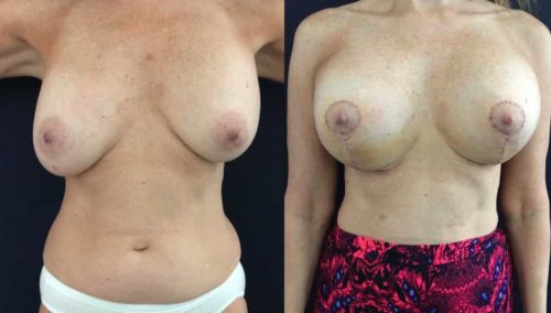 Before and after Breast Revision Colombia - Premium Care Plastic Surgery
