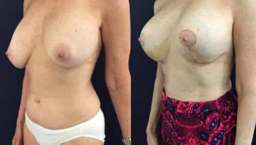 Before and after Breast Revision Colombia - Premium Care Plastic Surgery