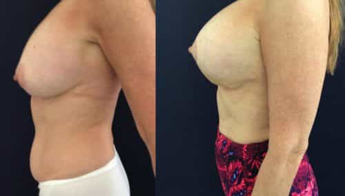 Before and after Breast Revision Colombia - Premium Care Plastic Surgery