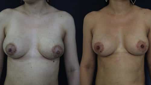 Before and after Breast Revision Colombia - Premium Care Plastic Surgery
