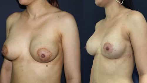 Before and after Breast Revision Colombia - Premium Care Plastic Surgery