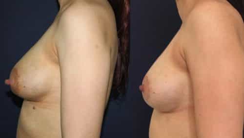 Before and after Breast Revision Colombia - Premium Care Plastic Surgery
