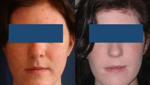 Before and After Buccal Fat Removal Colombia - Premium Care Plastic Surgery