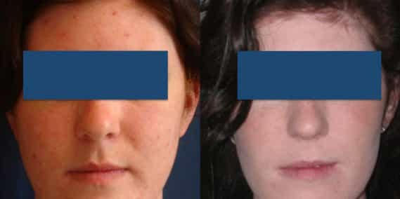 Before and After Buccal Fat Removal Colombia - Premium Care Plastic Surgery