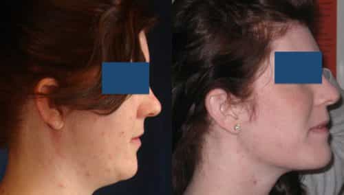 Before and After Buccal Fat Removal Colombia - Premium Care Plastic Surgery