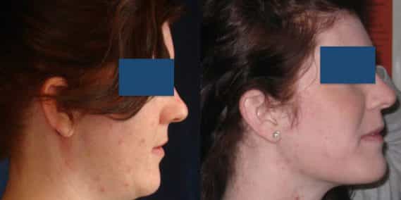 Before and After Buccal Fat Removal Colombia - Premium Care Plastic Surgery