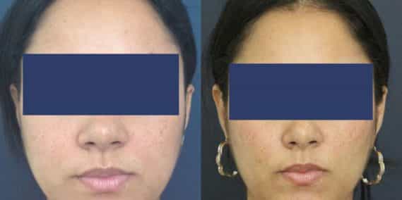 Before and After Buccal Fat Removal Colombia - Premium Care Plastic Surgery
