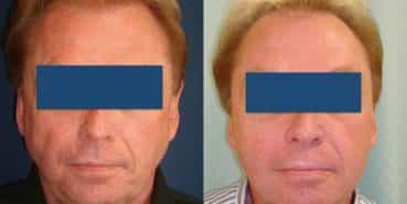 Facelift Colombia - Premium Care Plastic Surgery