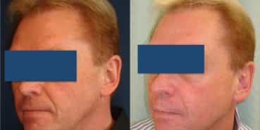 Facelift Colombia - Premium Care Plastic Surgery